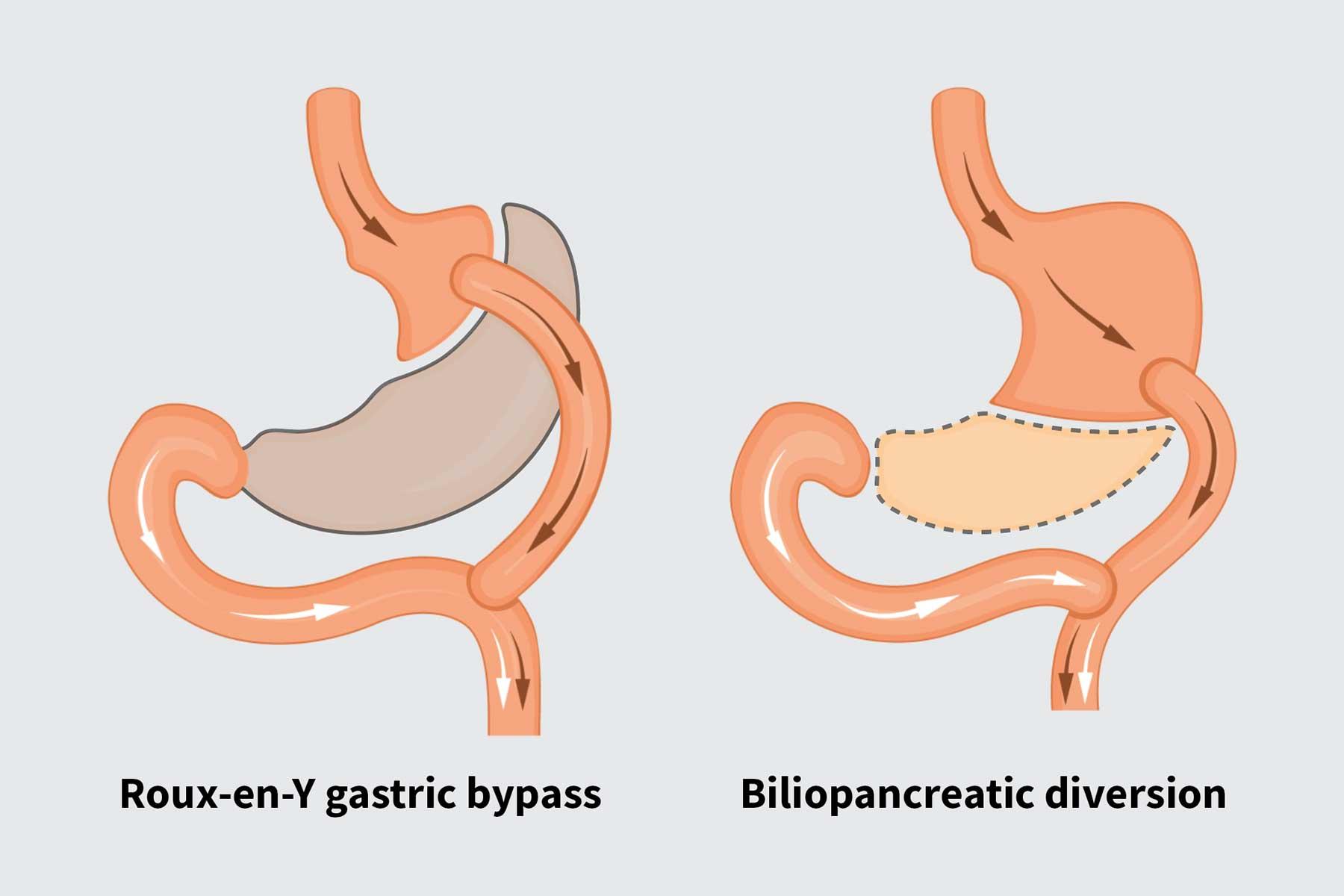 Long-Term Success After ‌Weight Loss Surgery